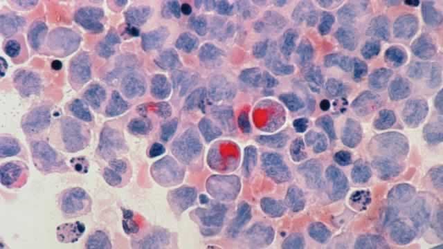 BioNTech, Bristol Myers Squibb Show Tumor Shrinkage In Lung Cancer Immunotherapy